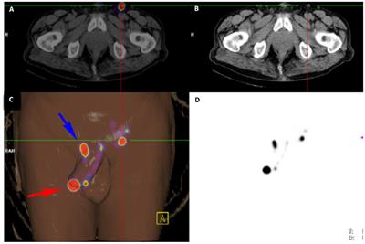 Interrogating the Impassable: A Case Series and Literature Review of Unilateral SPECT-CT Groin Visualization in Men With Penile Cancer